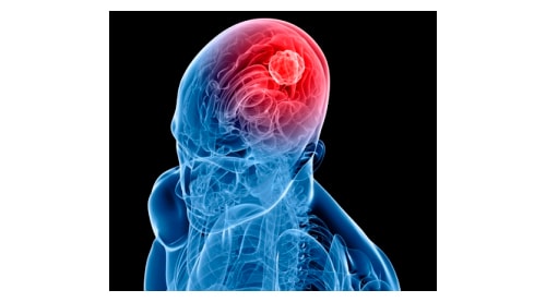 Cranial Tumour