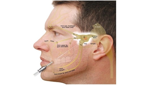 Trigeminal Neuralgia