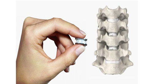 Cervical Disc Replacement Surgery