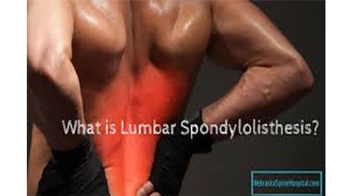 Lumbar Spondylolisthesis