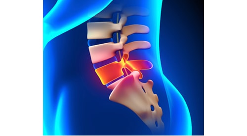 Lumbar Spine Fusion Surgery