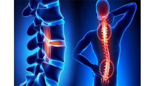 Spine Surgery